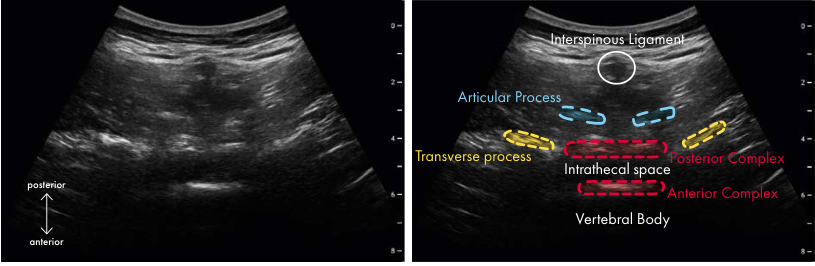Original ultrasound panel from the Neuraxial poster
